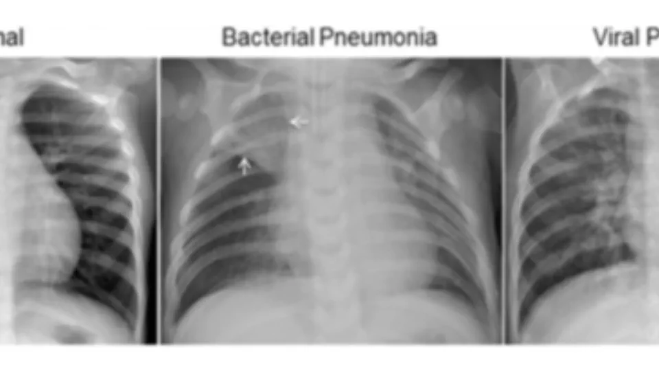 Deep Learning for Pneumonia Diagnosis: A Study on Chest X-ray Image Classification
