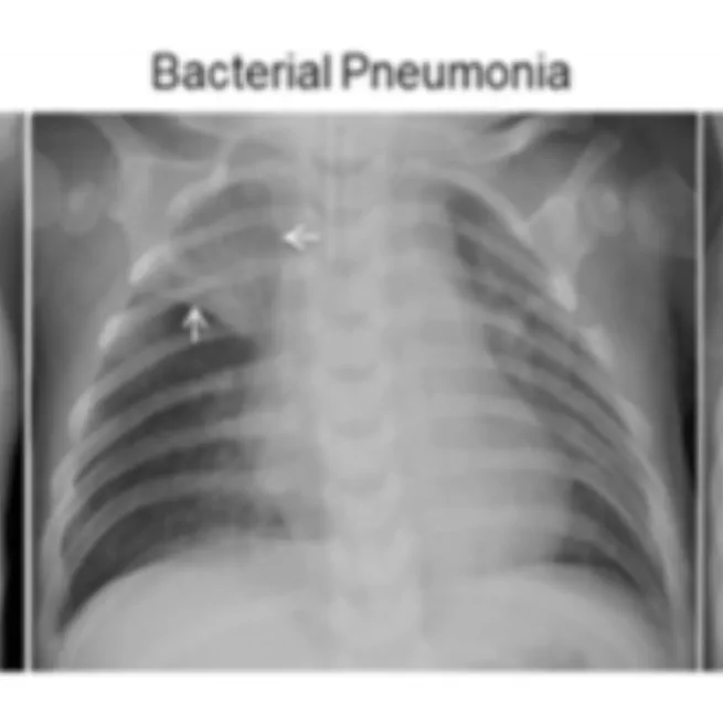 Deep Learning for Pneumonia Diagnosis: A Study on Chest X-ray Image Classification